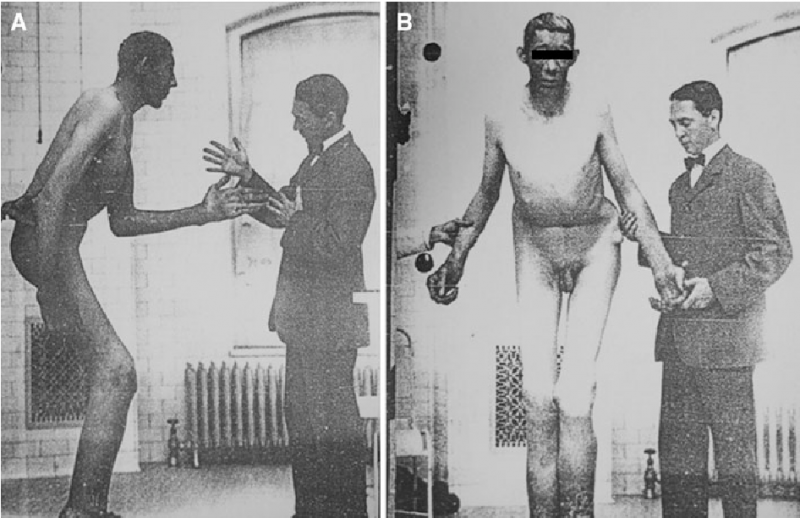 透納是知名的巨人，早逝於36歲，死後遭庫欣不道德解剖，卻也成為「肢端肥大症」的研究先例。（圖片來源 / ）