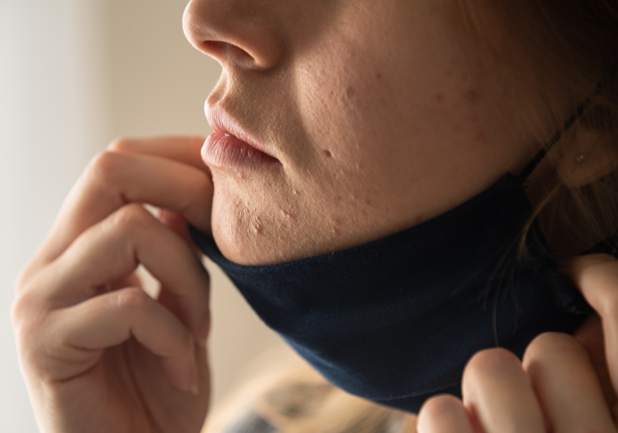 口罩痘maskne在這一年是全球的熱門關鍵字，其中長時間戴口罩的摩擦是造成粉刺和痘痘的主因